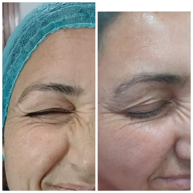 Botox before and after, softer forehead and eye lines