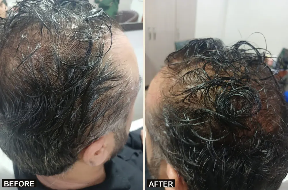 PRP and mesotherapy before and after for hair restoration