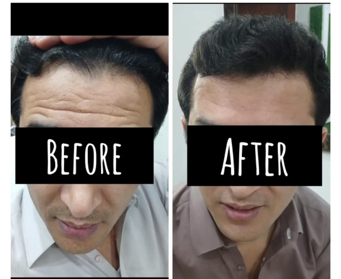 Botox before and after, forehead lines smoothed with natural expression preserved