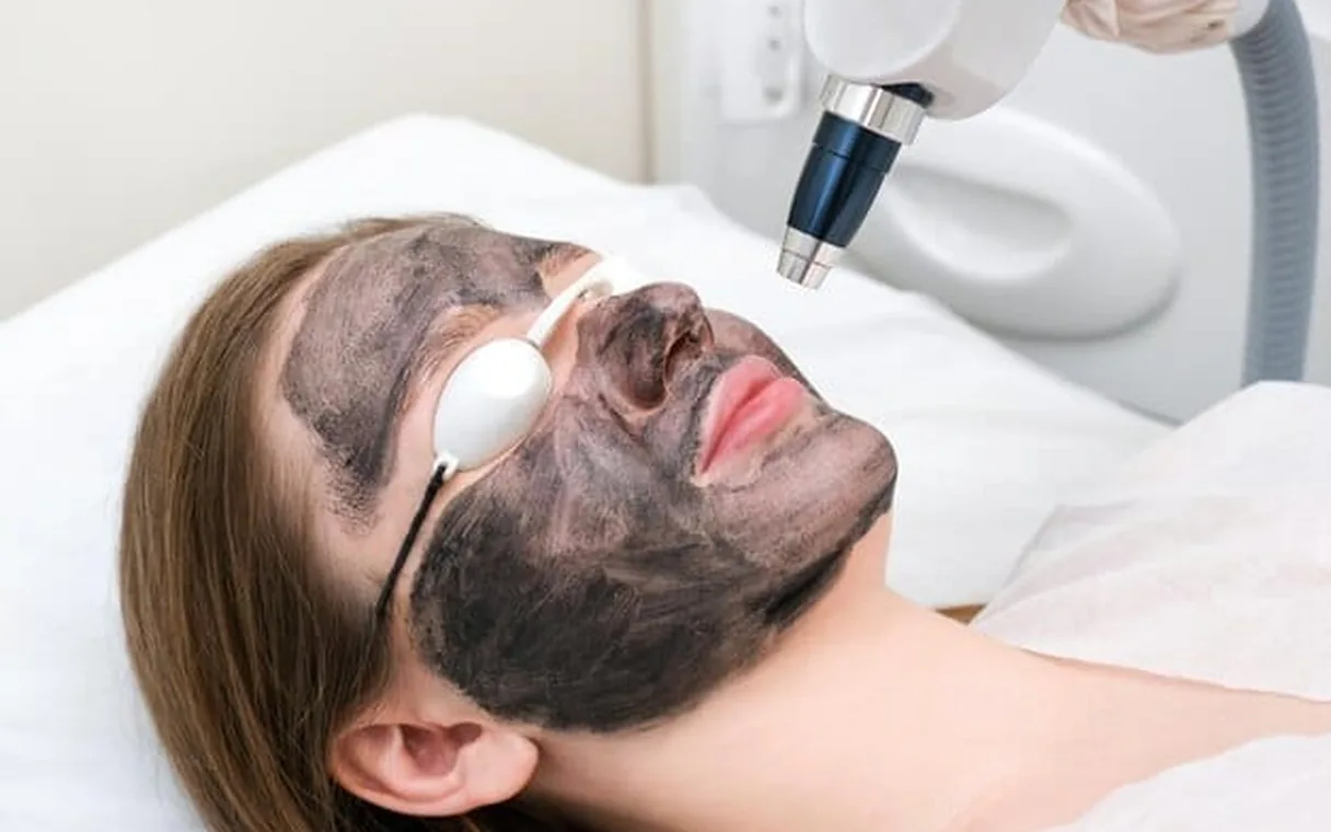 Carbon Laser Peel Price in Pakistan 2026