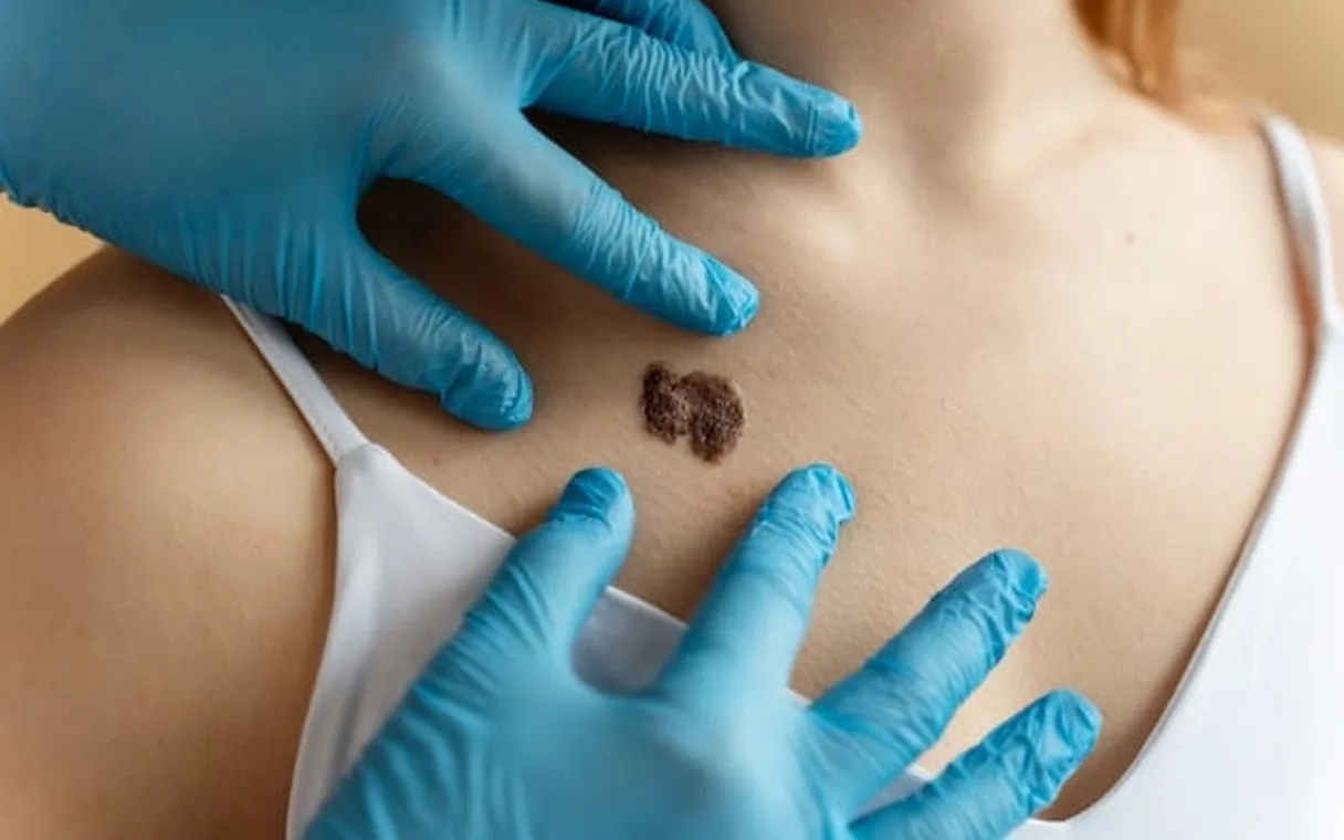Infected Moles: Signs, Safe Care, and When to See a Doctor