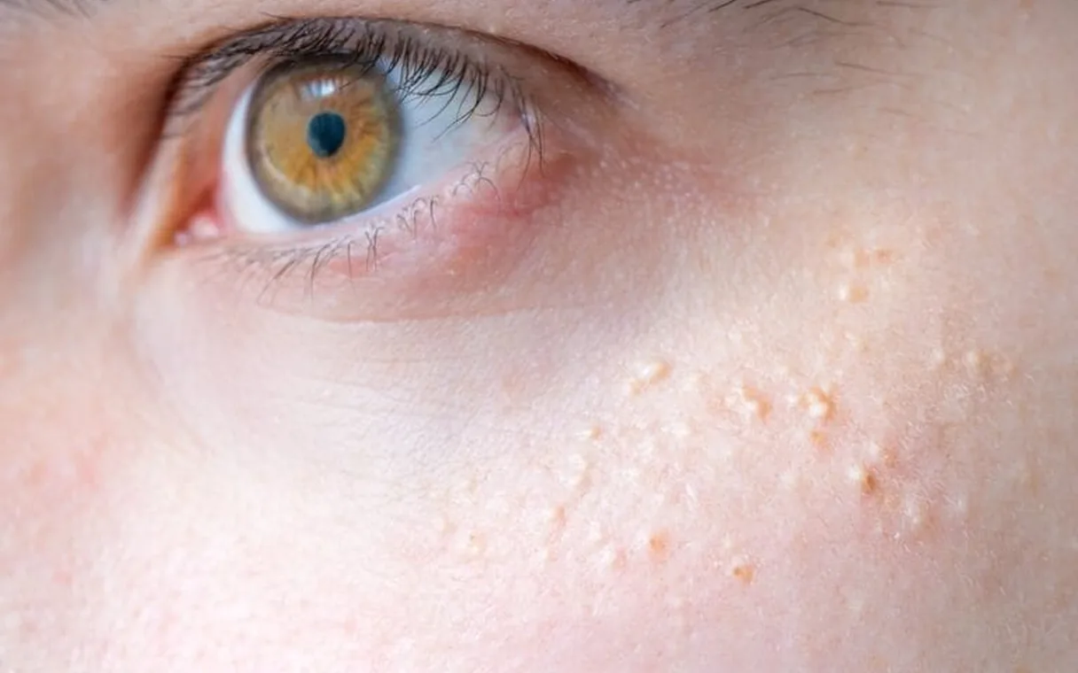 Milia Removal in Islamabad: Is Laser Ablation the Best Option?