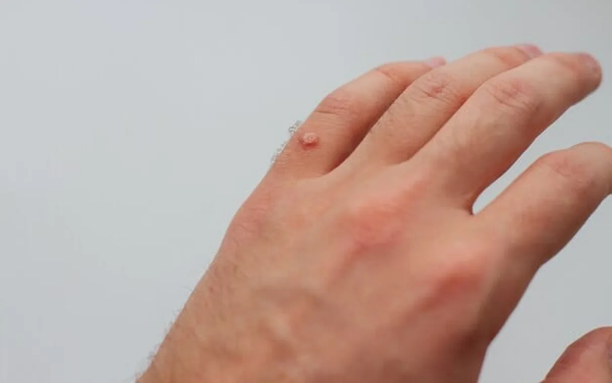 Laser Wart Removal in Islamabad: Safe, Effective Treatment