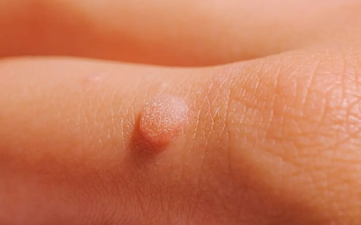 Skin Tag Removal on the Face: Safe Options That Work