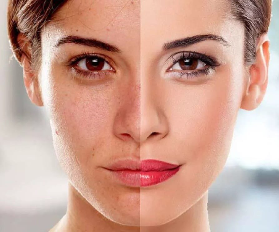 Skin Whitening Treatment in Islamabad
