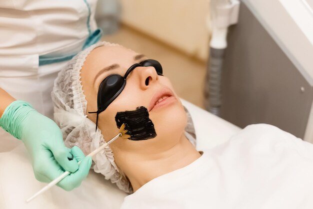Benefits of Black Doll Carbon Laser Peel in Islamabad