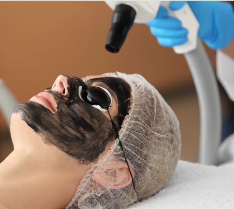 Black Doll Carbon Laser Peel in Islamabad
