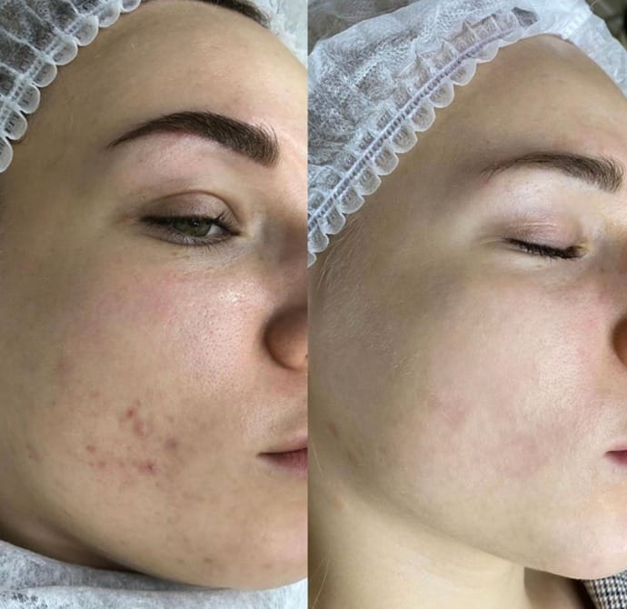 Black Doll Carbon Laser Peel in Islamabad