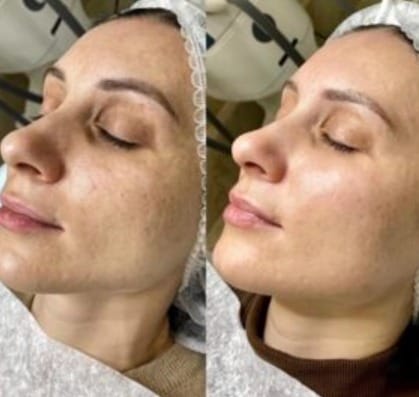 Black Doll Carbon Laser Peel in Islamabad
