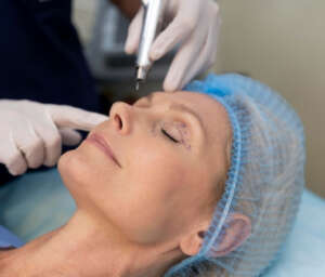 Face Thread Lift