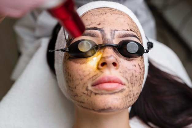 Benefits of Black Doll Carbon Laser Peel in Islamabad
