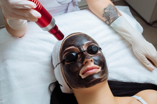 Black Doll Carbon Laser Peel for Acne Scars in Islamabad