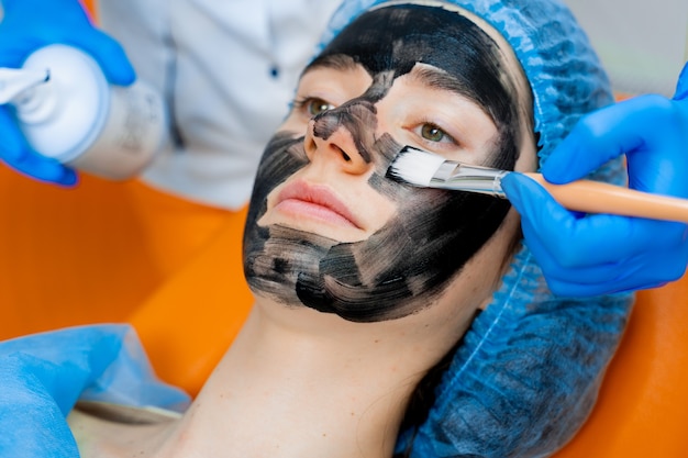 Black Doll Carbon Laser Peel for Acne Scars in Islamabad