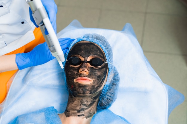 Black Doll Carbon Laser Peel for Acne Scars in Islamabad