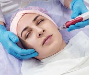 PRP  Face Treatment