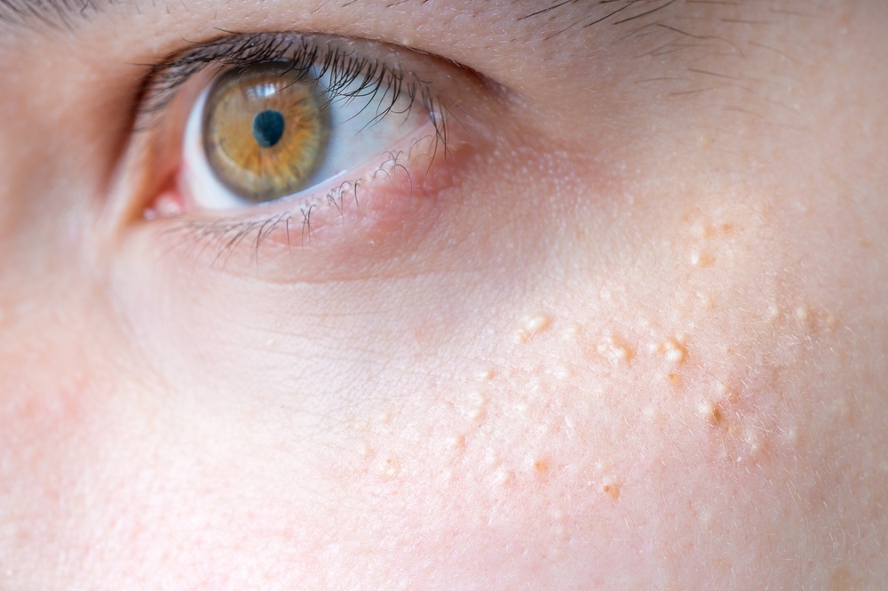 Understanding Laser Treatment for Moles, Warts, and Milia
