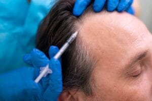 How PRP Treatment Boosts Hair Growth in Islamabad