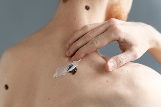 Safe and Effective Wart Removal with Laser Technology in Islamabad
