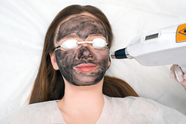 Carbon Laser Peel for Acne Scars: Results and Benefits