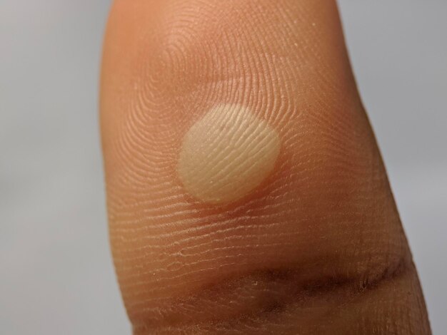 Safe and Effective Wart Removal with Laser Technology in Islamabad
