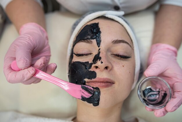 Carbon Laser Peel for Acne Scars: Results and Benefits