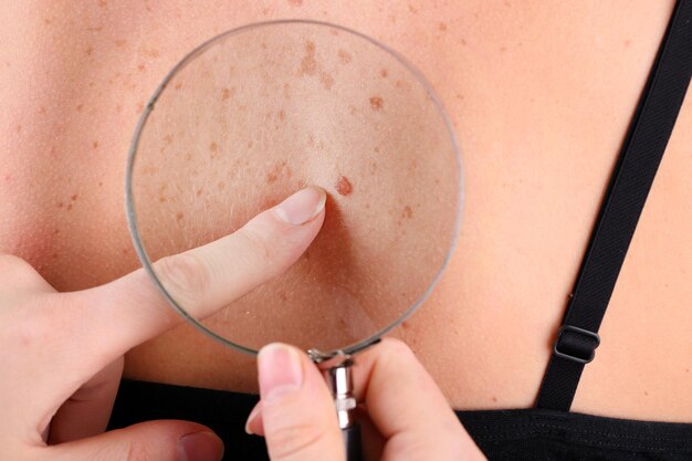 Top Benefits of Laser Ablation for Skin Tags in Islamabad