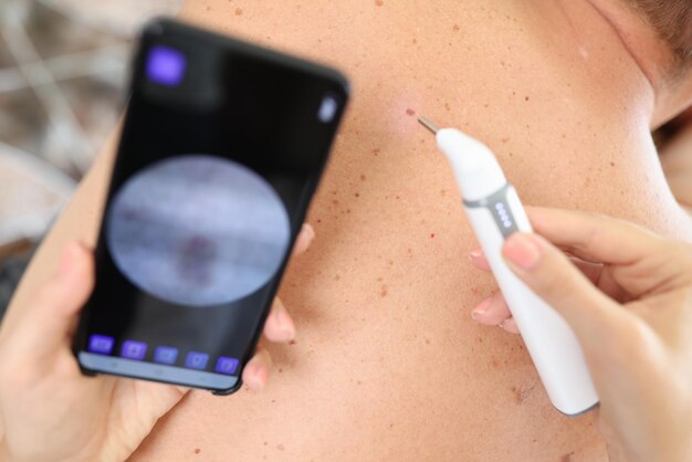 Understanding Laser Treatment for Moles, Warts, and Milia
