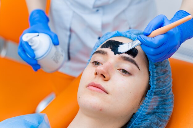 Carbon Laser Peel for Acne Scars: Results and Benefits