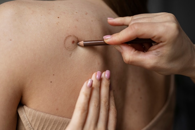 Is Laser Skin Treatment for Moles Worth the Investment?