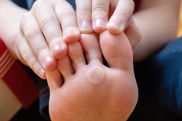 Safe and Effective Wart Removal with Laser Technology in Islamabad
