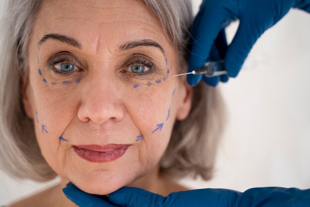 Thread Face Lift: How Long Does It Really Last?