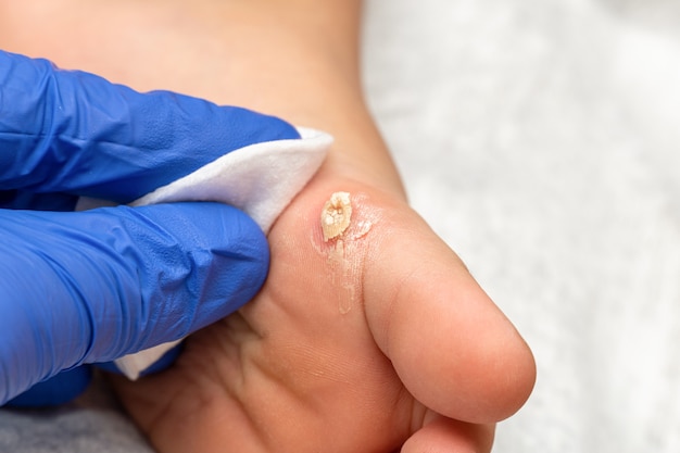 Safe and Effective Wart Removal with Laser Technology in Islamabad
