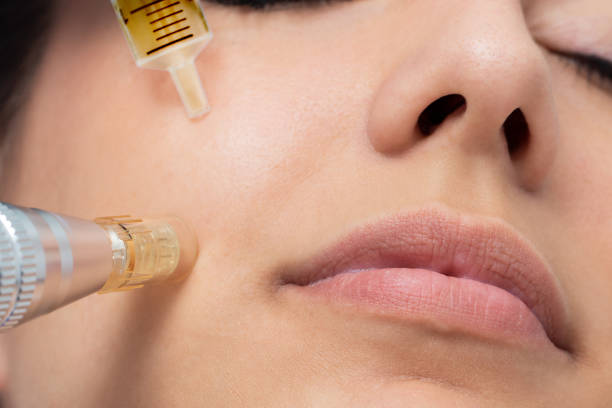 What is Mesotherapy for the Face? Fat Reduction and Skin Benefits