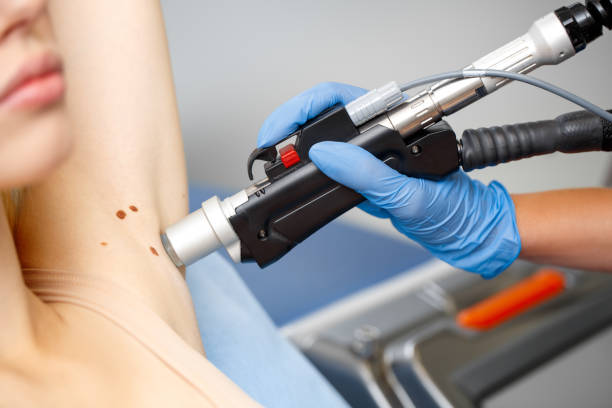 Understanding Laser Treatment for Moles, Warts, and Milia
