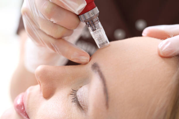 What is Mesotherapy for the Face? Fat Reduction and Skin Benefits