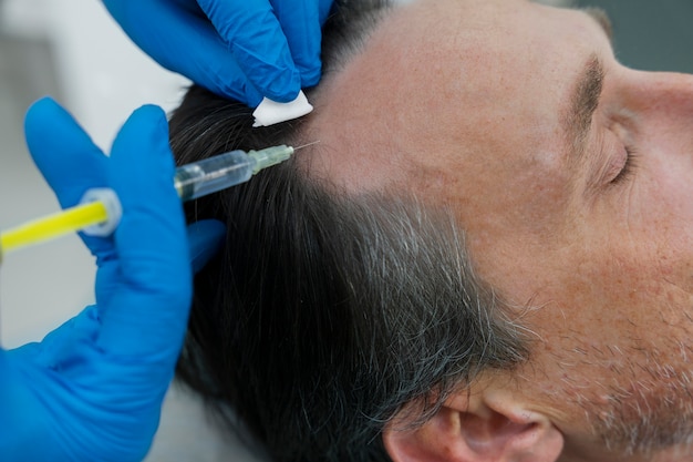 Top Benefits of PRP Hair Treatment in Islamabad