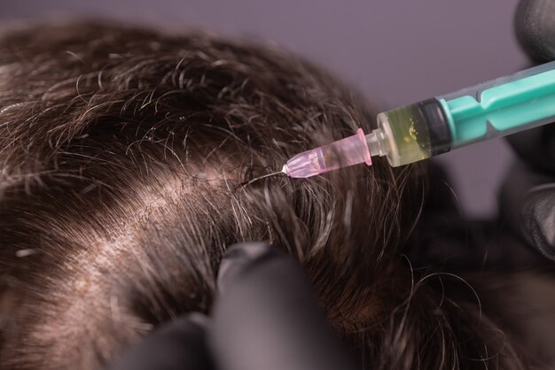 PRP vs Other Hair Loss Treatments: Why Choose PRP?
