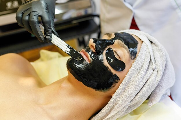 Carbon Laser Peel for Acne Scars: Results and Benefits