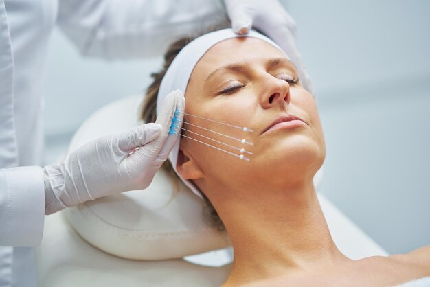 Thread Lift Treatment Explained: Benefits and Results