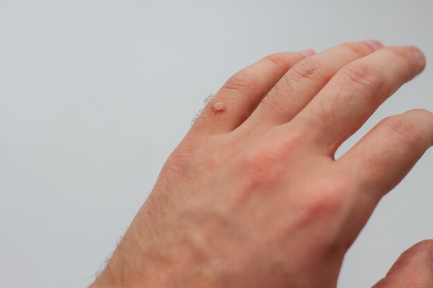 Understanding Laser Treatment for Moles, Warts, and Milia
