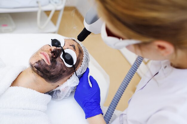 Carbon Laser Peel for Acne Scars: Results and Benefits