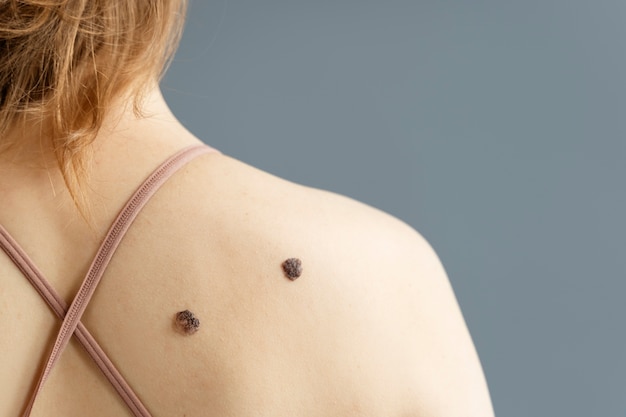 Top Benefits of Laser Ablation for Skin Tags in Islamabad