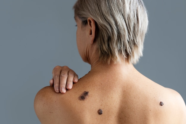 Black Mole Treatment: How to Safely Remove and Treat Moles