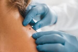 Mole Removal Treatment: Safe Solutions for All Types of Moles
