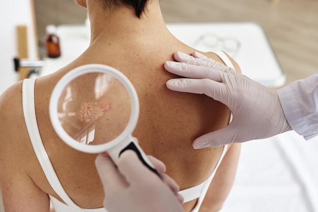Laser Treatment for Removing Moles: Benefits & Costs