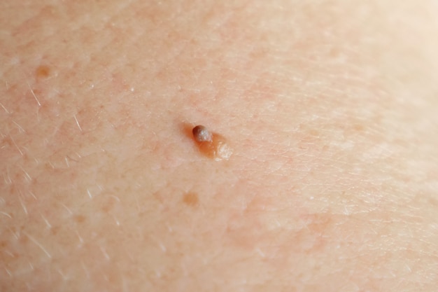 Laser Treatment for Skin Tags: Safe Solutions for Removal