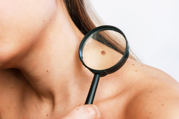 Laser Treatment for Skin Tags: Safe Solutions for Removal