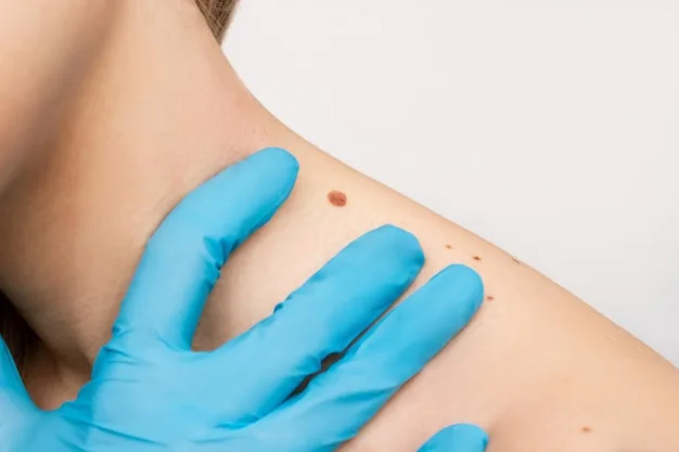 Infected Mole Treatment: How to Safely Treat Infected Moles