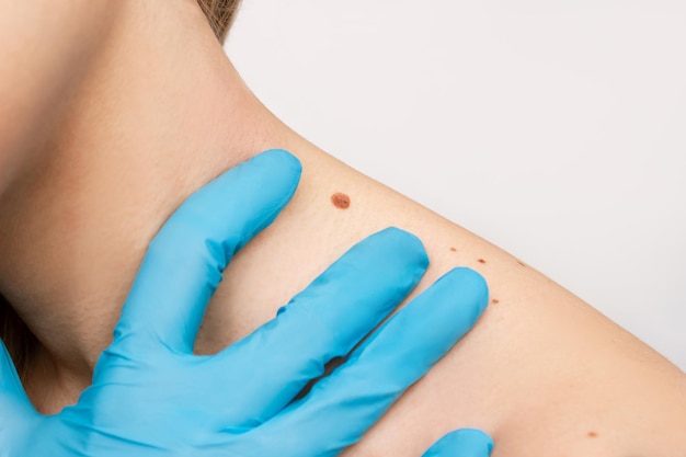 Laser Treatment for Removing Moles: Benefits & Costs