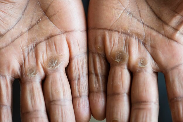 Skin Warts Treatment: Effective Methods to Treat Warts